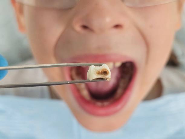 Best Emergency Dental Care for Broken or Chipped Teeth in Lansing, IL